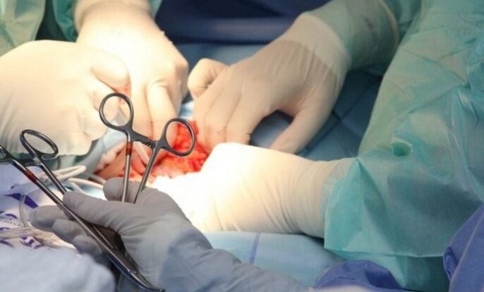Ligamentotomie – chirurgie d’agrandissement du pénis